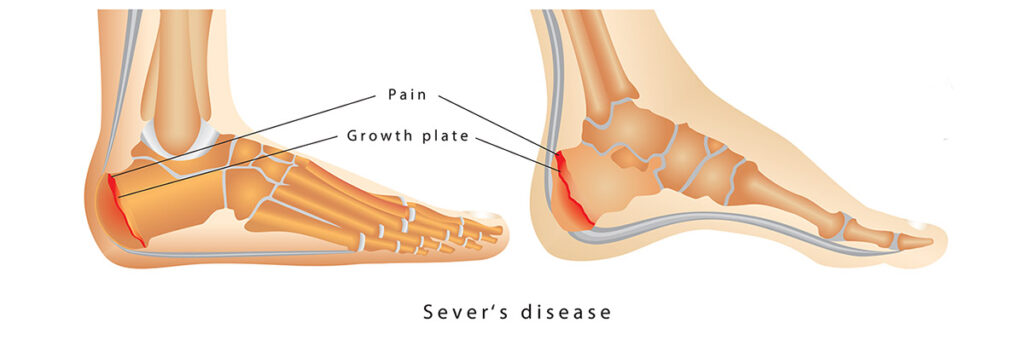 Sever's hot sale disease foot