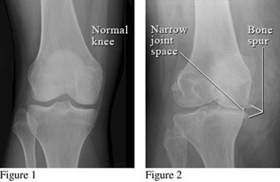 Knee Osteoarthritis (OA) evaluation