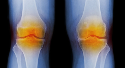 Knee Osteoarthritis (OA)